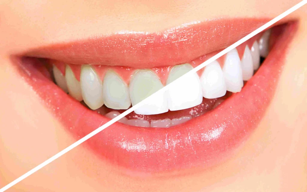 Un sourire éclatant en toute simplicité : tout savoir sur le blanchiment dentaire